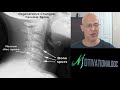 The Difference Between Spondylosis & Ankylosing Spondylitis -  Dr Alan Mandell, DC