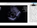 Parasternal Short Axis view (PSAX) - Neonatal Echocardiography