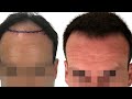 3000 FUE Hair Transplant Result | Before & After Shown 3,6,9,12 Months. #hairtransplantresults