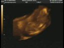 Cambree Christensen 3D Ultrasound Part 2