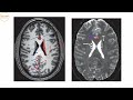 Neurosurgery Basics Lecture : Neuroradiologic Anatomy Part 3