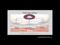 Introduction to Pulmonary Arterial Hypertension with Dr. Karim El-Kersh