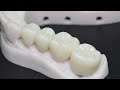 Types of Dental Crowns and Materials - Gold, Porcelain, Lithium Disilicate, & Zirconia