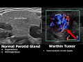 Salivary Glands Ultrasound Normal Vs Abnormal Images | Parotid, Submandibular & Sublingual Gland USG