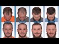 FUE Hair Transplant | Nick 8 Months Post ARTAS Hair Transplant