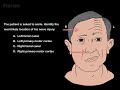 Bells Palsy and Stroke