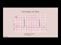 Bradyarrhythmias - CRASH! Medical Review Series