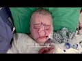 Youngest Face Transplant Recipient in U.S. | National Geographic