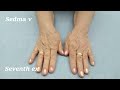Vežbe za jutarnju ukočenost šaka i prstiju   Exercises for morning stiffness of hands and fingers