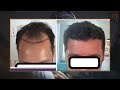 FUE HAIR TRANSPLANT SURGERY RESULT|  PATIENT HAS BETTER HAIR LINE THAN EVER. #hairtransplantresults