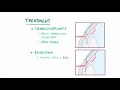 Glaucoma | Clinical Presentation