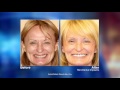 No More Loose Dentures with Mini-Dental Implants with Las Vegas Dentist Harvey Chin, DDS