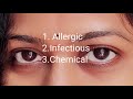 Conjunctivitis(కండ్ల కలక )types,symptoms, self care in telugu|by Suni's health and home science.