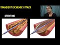 Transient Ischemic Attack (TIA) Emergency Treatment & Management, Symtoms, Medicine Lecture USMLE