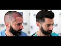 FUE Hair Transplant (2491 Grafts NW III A) By Dr Juan Couto - FUEXPERT CLINIC, Madrid, Spain