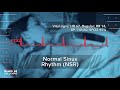 ACLS Megacode Scenario 1: Supraventricular Tachycardia (SVT)