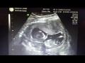 Two Guys and a Hopeful Baby - 13 Week Checkup