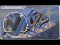 EVEREST® Minimally Invasive Surgical Technique Animation