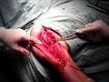 Cirugía de Mano, fractura de húmero 01