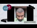 First Head Wash After Hair transplant || Teluguhairtansplantips