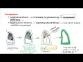 Pleural Effusion - Transudate or Exudate - Causes and Liddle’s Criteria -Pulmonary Medicine Playlist