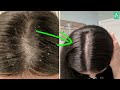 Dandruff, Hair Fall Aur Hair Fungus Ka Permanent Solution | Dandruff Causes And Home Remedy.