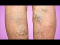 Why do my legs swell? Water retention or inflammation?