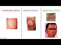 Leprosy (Hansen's disease) | Who is at risk, Signs and Symptoms, Diagnosis, and Treatment