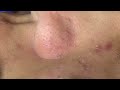 Blackheads, Acne Puberty P1 | Mụn Đầu Đen, Mụn Tuổi Dậy Thì P1 - SacDepSpa#280