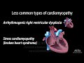 Cardiomyopathy, animation