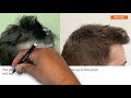 2375 FUE Hair Transplant Result (0-6 Months) | Dr Christian Bisanga (BHR Clinic)