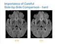 MRI Uses in MS