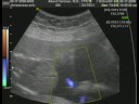 Cambree Christensen 3D Ultrasound Part 1