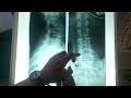 Analiza kičme - Milan Ivovic - Gonstead kiropraktika